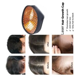 Laser Scalp Oil Control and Hair Growth, Hairline Remodeling Device, Sparse Top of The Head and Densification