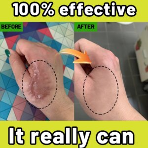 Remove pimples on hands and feet, and repair skin after injury