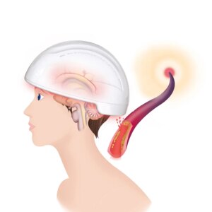 Infrared Led Light rMTS 810nm Deep Penetration PBM Brain Helmet for Alzheimerdredge pulse physiotherapy instrument