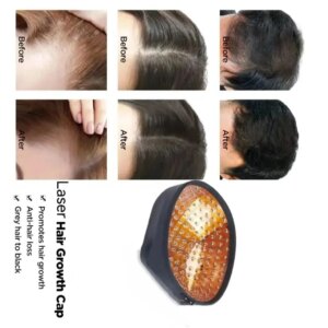 96 Diodes Stimulates Dormant Follicles Reduces Hair Shedding – Strengthens Roots To Minimize Excessive Daily Loss