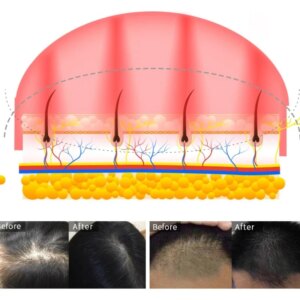 180 PCS Hair Growth Hat Red Light Therapy Cap Helmet For Hair Loss Treatment